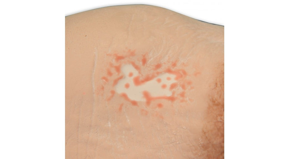 Vinnie Venous Insufficiency Leg