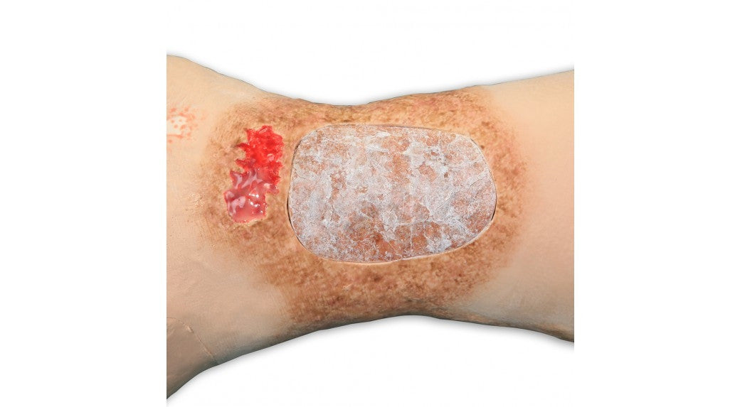 Vinnie Venous Insufficiency Leg