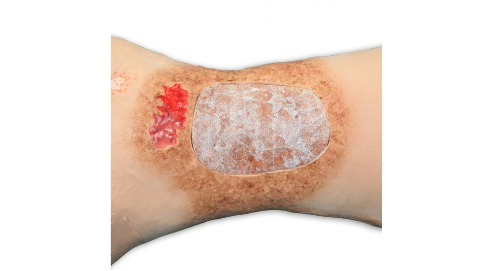 Vinnie Venous Insufficiency Leg