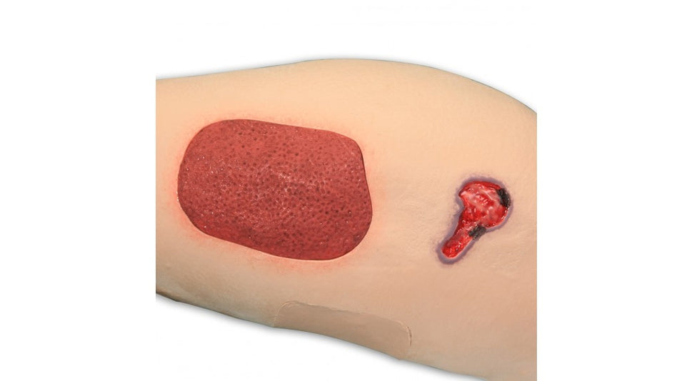 Vinnie Venous Insufficiency Leg