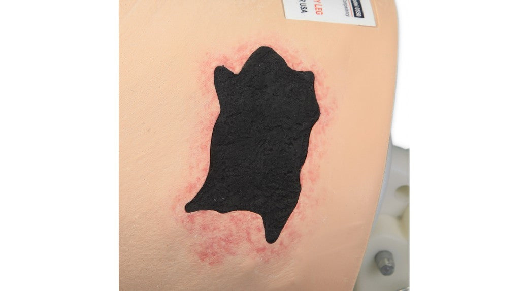 Vinnie Venous Insufficiency Leg