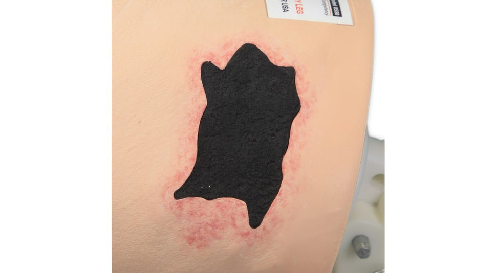 Vinnie Venous Insufficiency Leg