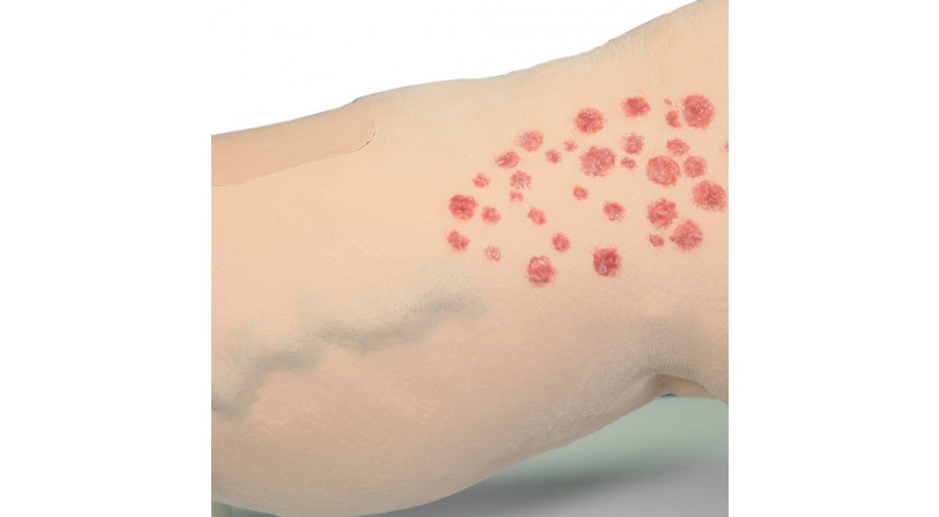 Vinnie Venous Insufficiency Leg