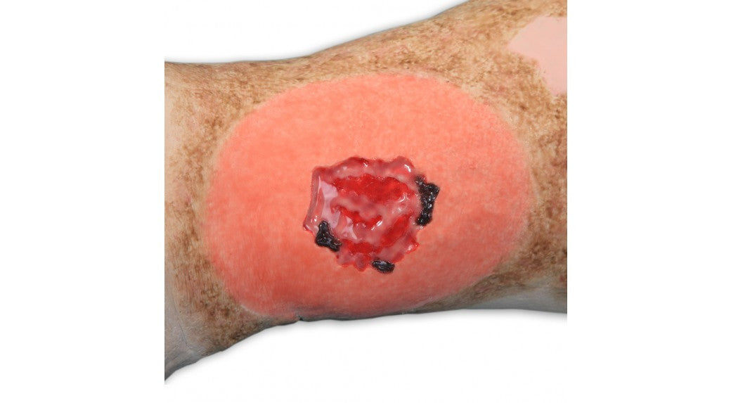 Vinnie Venous Insufficiency Leg