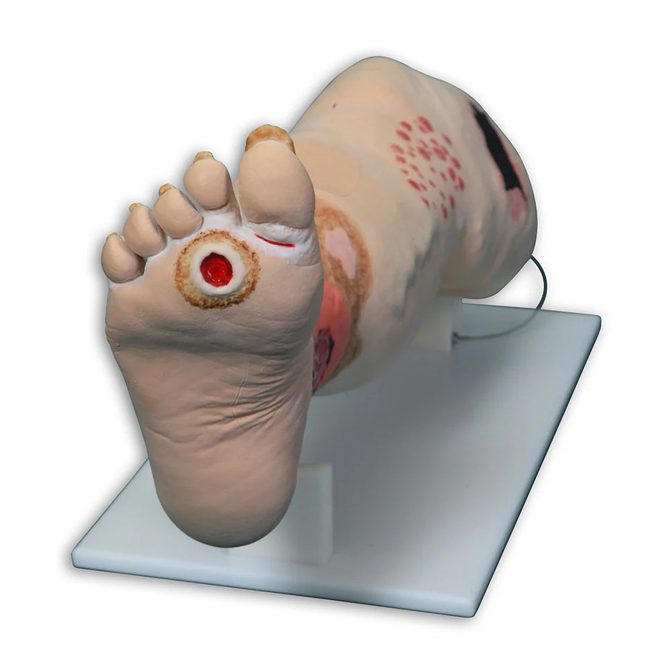 Vinnie Venous Insufficiency Leg