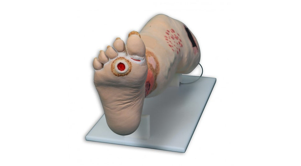 Vinnie Venous Insufficiency Leg