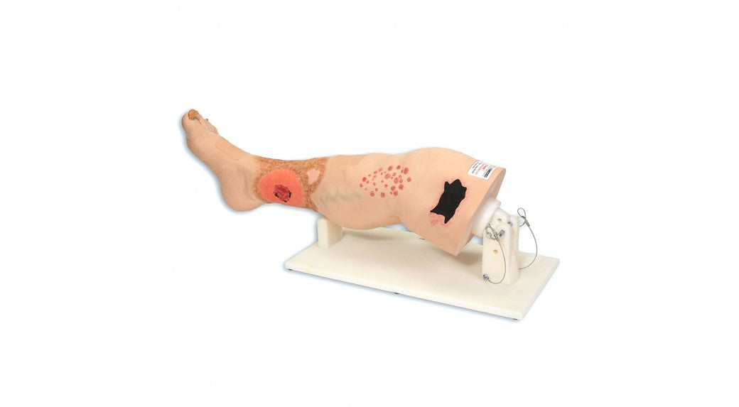 Vinnie Venous Insufficiency Leg