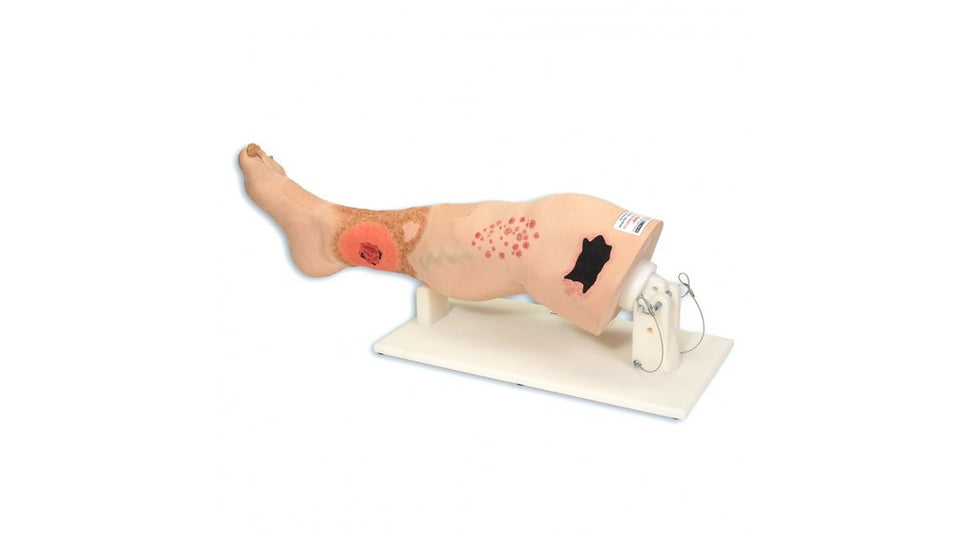 Vinnie Venous Insufficiency Leg