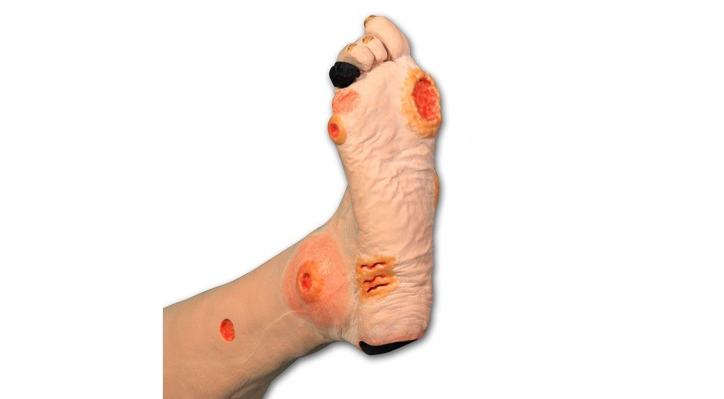 Annie Arterial Insufficiency Leg