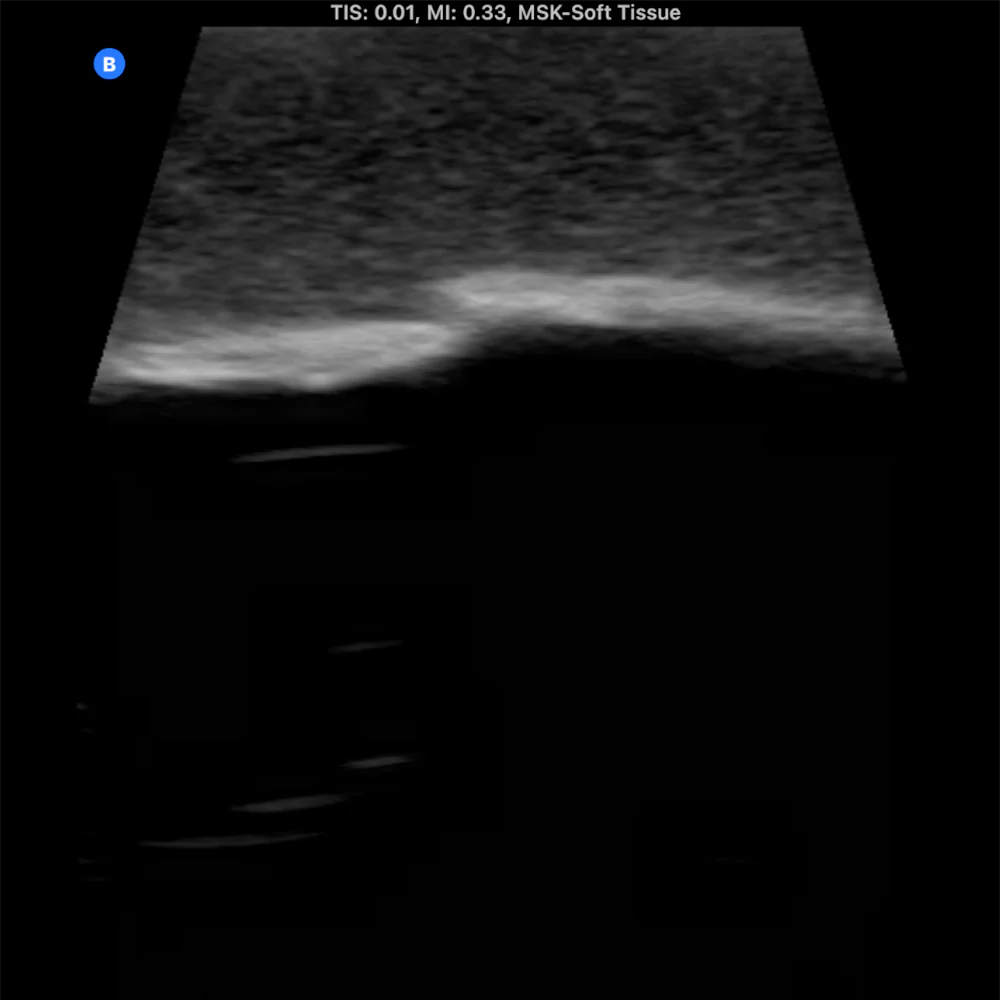 Ultrasound Phantom Bone Fracture