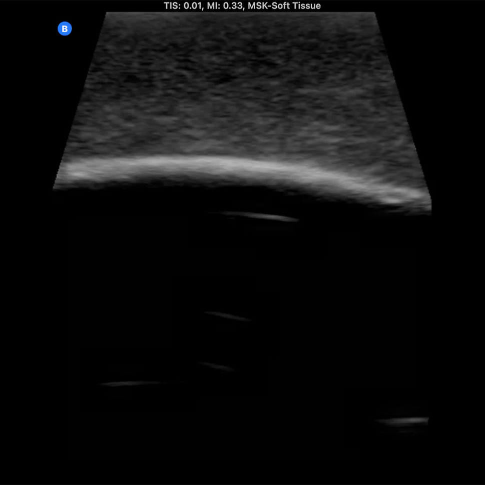 Ultrasound Phantom Bone Fracture