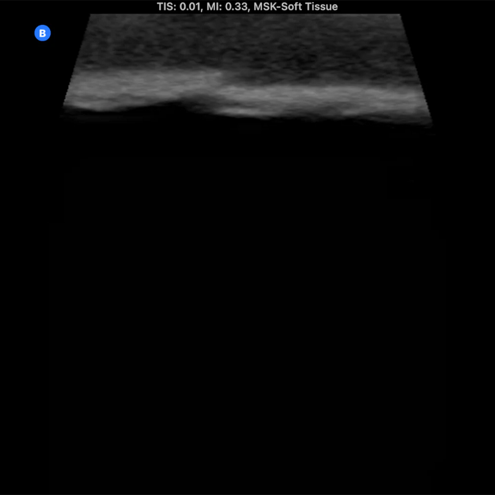 Ultrasound Phantom Bone Fracture