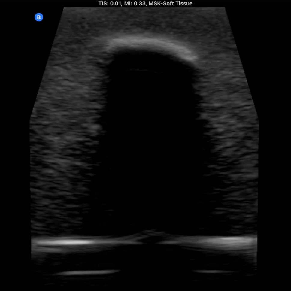 Ultrasound Phantom Bone Fracture
