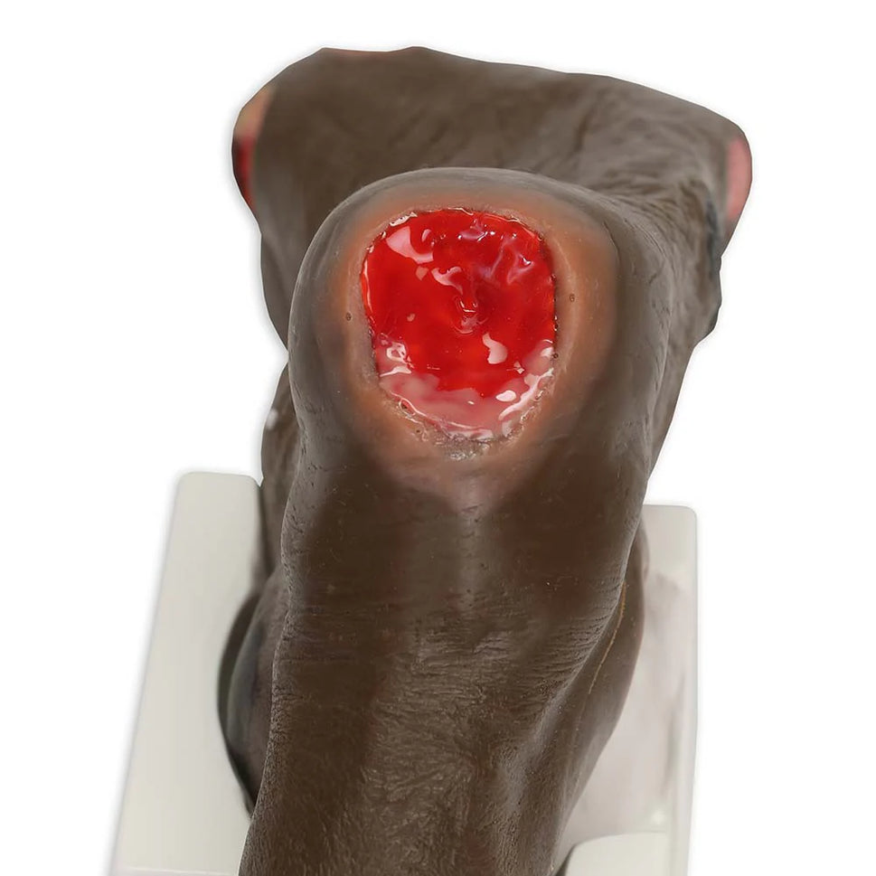 Wilma Wound Foot Trainer