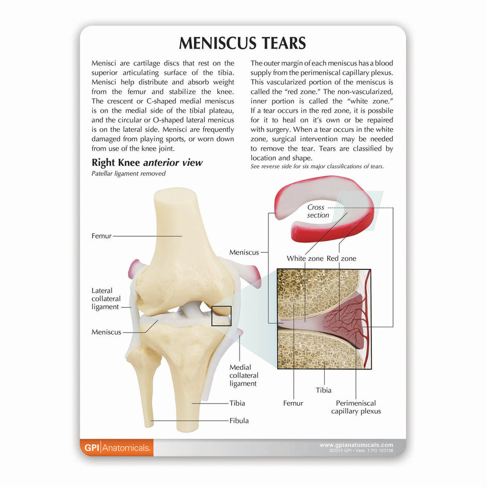 Knee Meniscus Tears Model