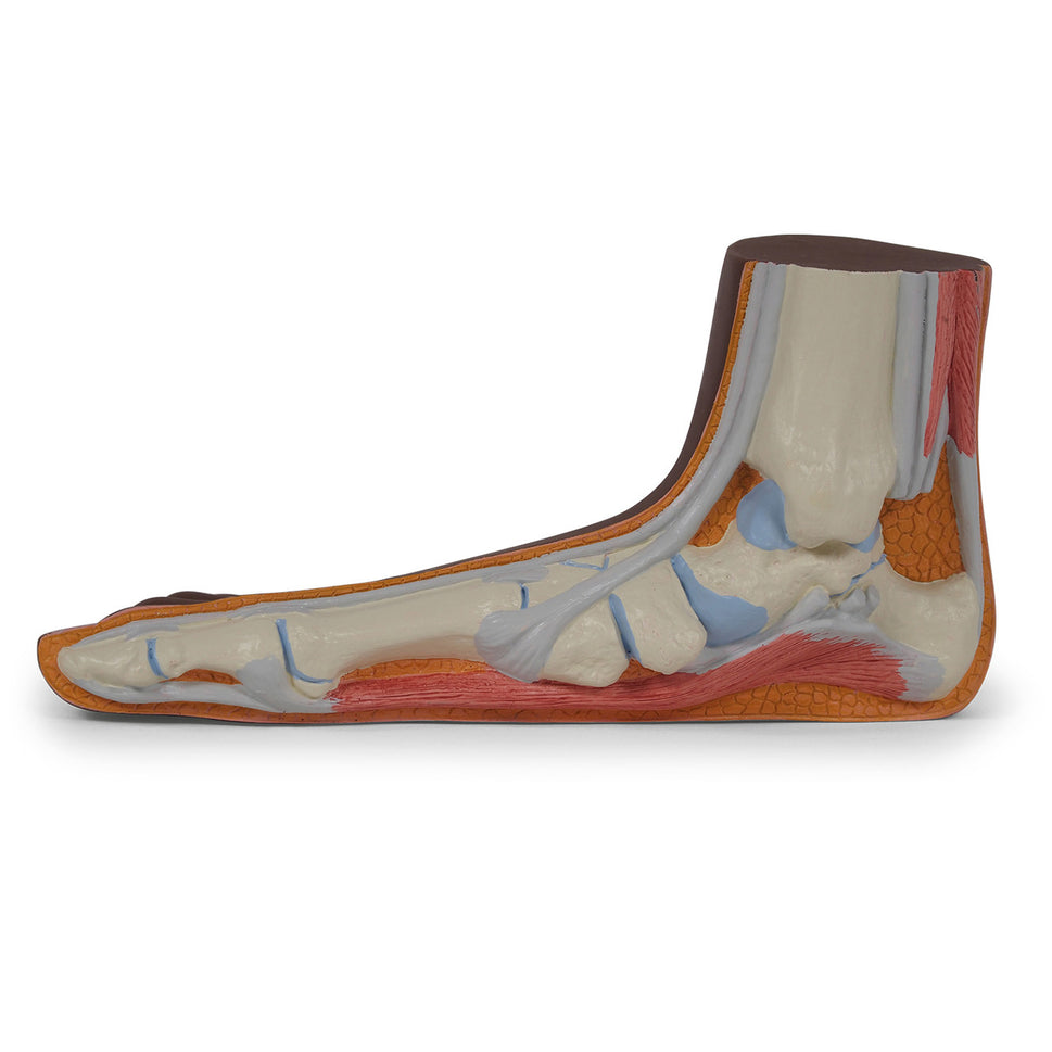 Flat Foot Model (Pes Planus)