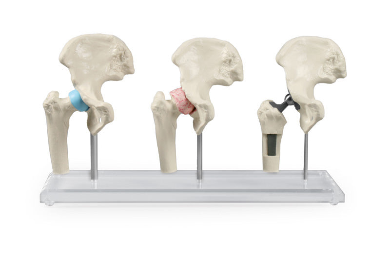 Hip Implant / Replacement Model Set (3 part)