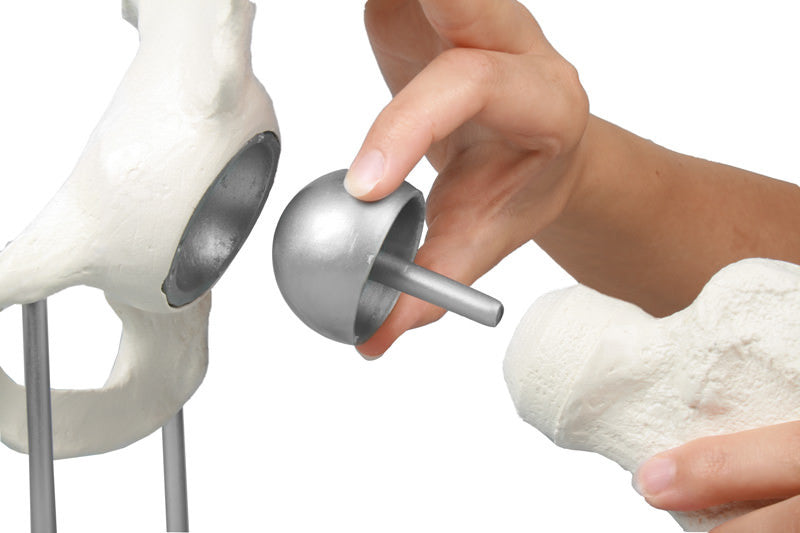 Hip Joint Model with Birmingham Hip Resurfacing