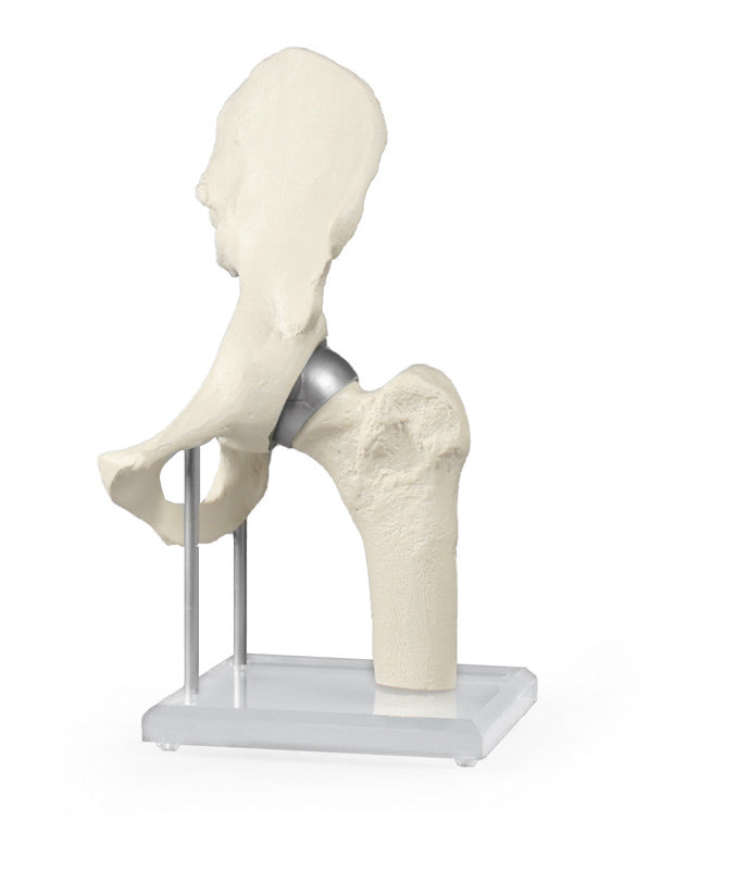 Hip Joint Model with Birmingham Hip Resurfacing