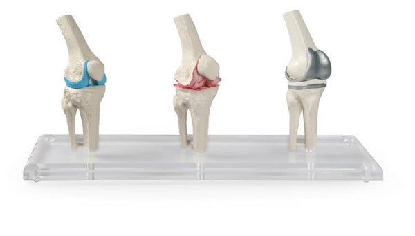 Knee Implant / Replacement Model Set (3 part)