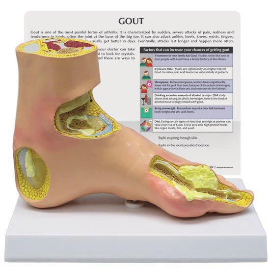 Gout Foot Model