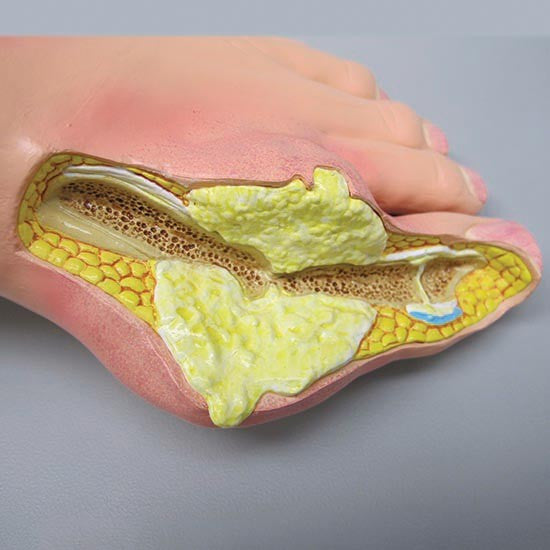 Gout Foot Model