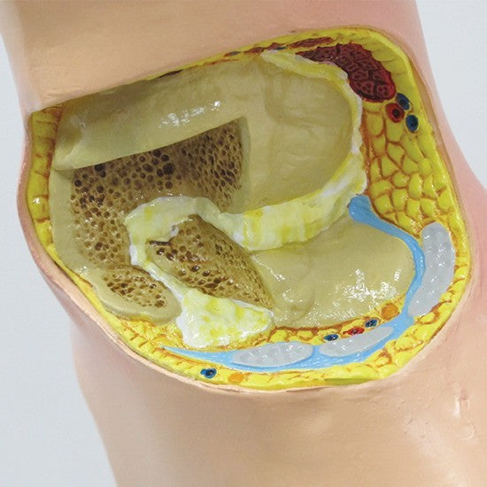 Gout Foot Model