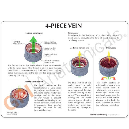 Vein Model with Thrombosis (4 part)