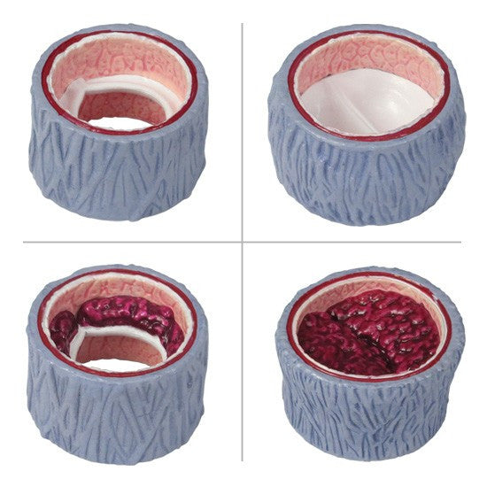 Vein Model with Thrombosis (4 part)