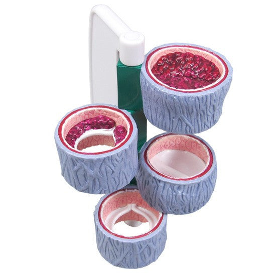 Vein Model with Thrombosis (4 part)