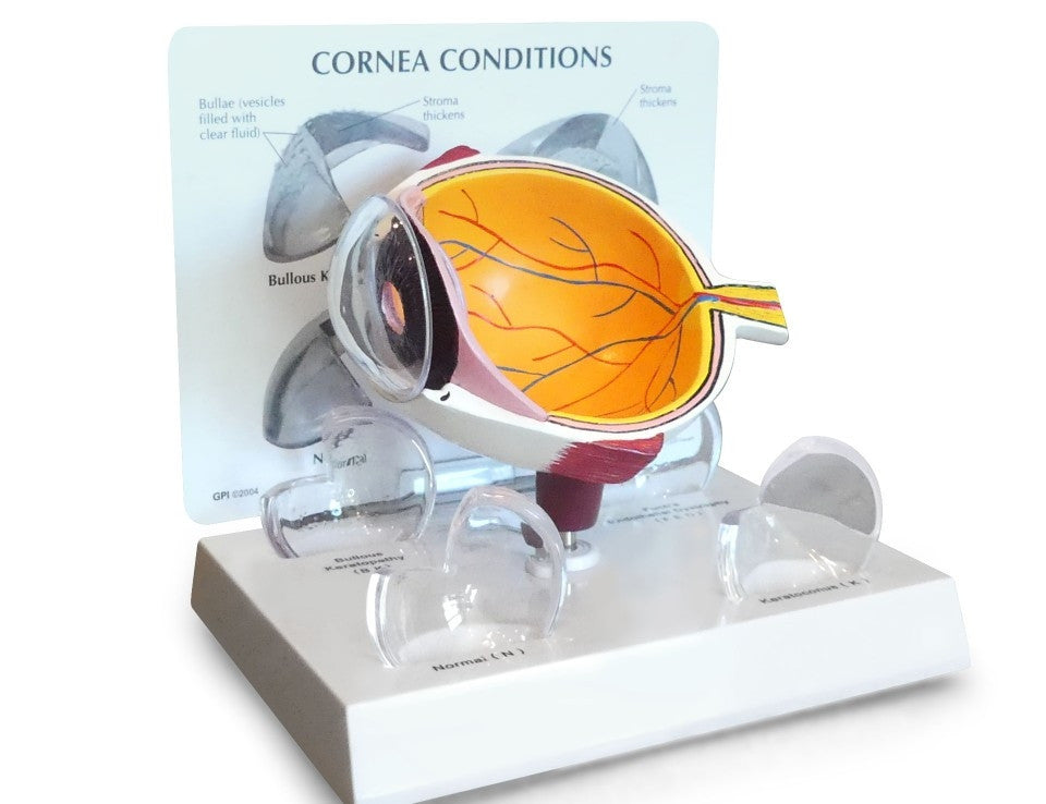 Cornea Conditions Eye Model