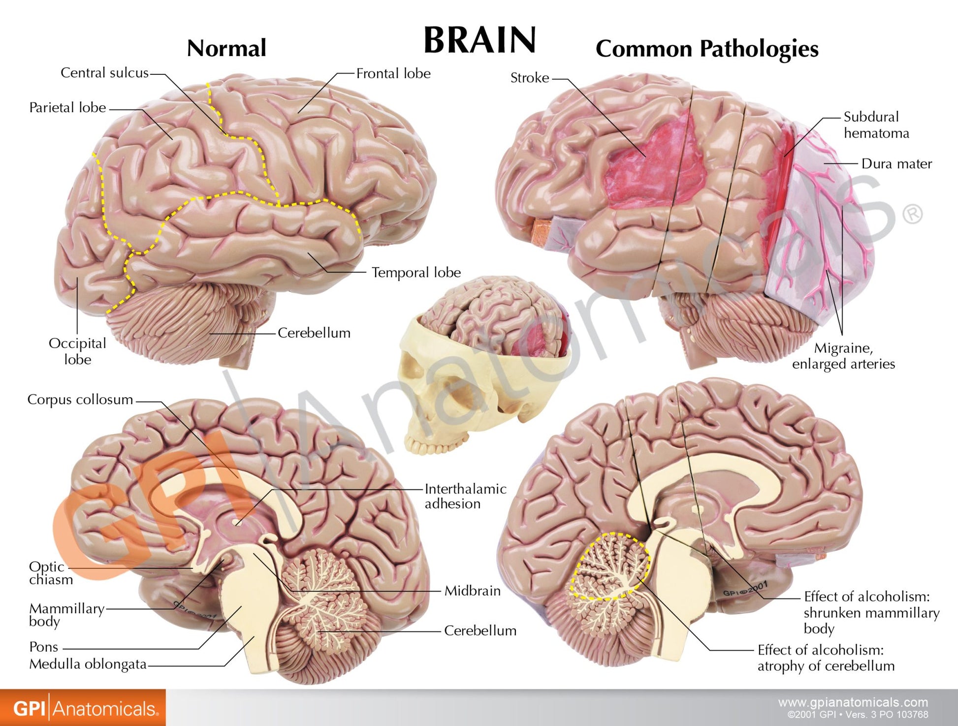 Diseased Brain in Skull Model
