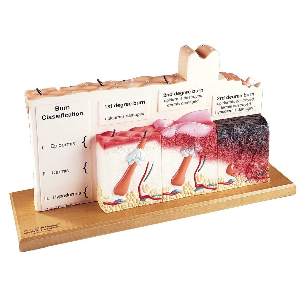Human Skin Series with Burn Pathologies Model (75 times life size)