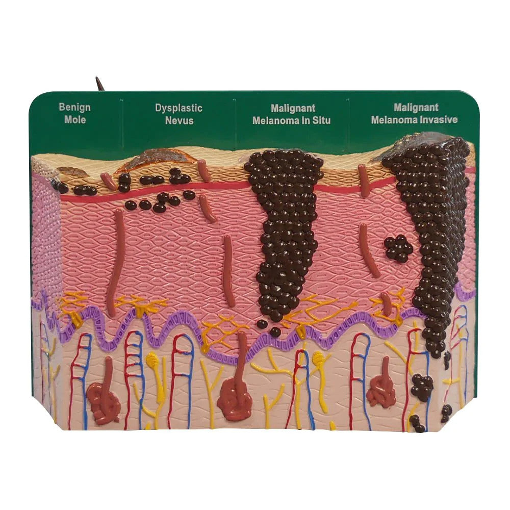 2-Sided Skin Cancer Model