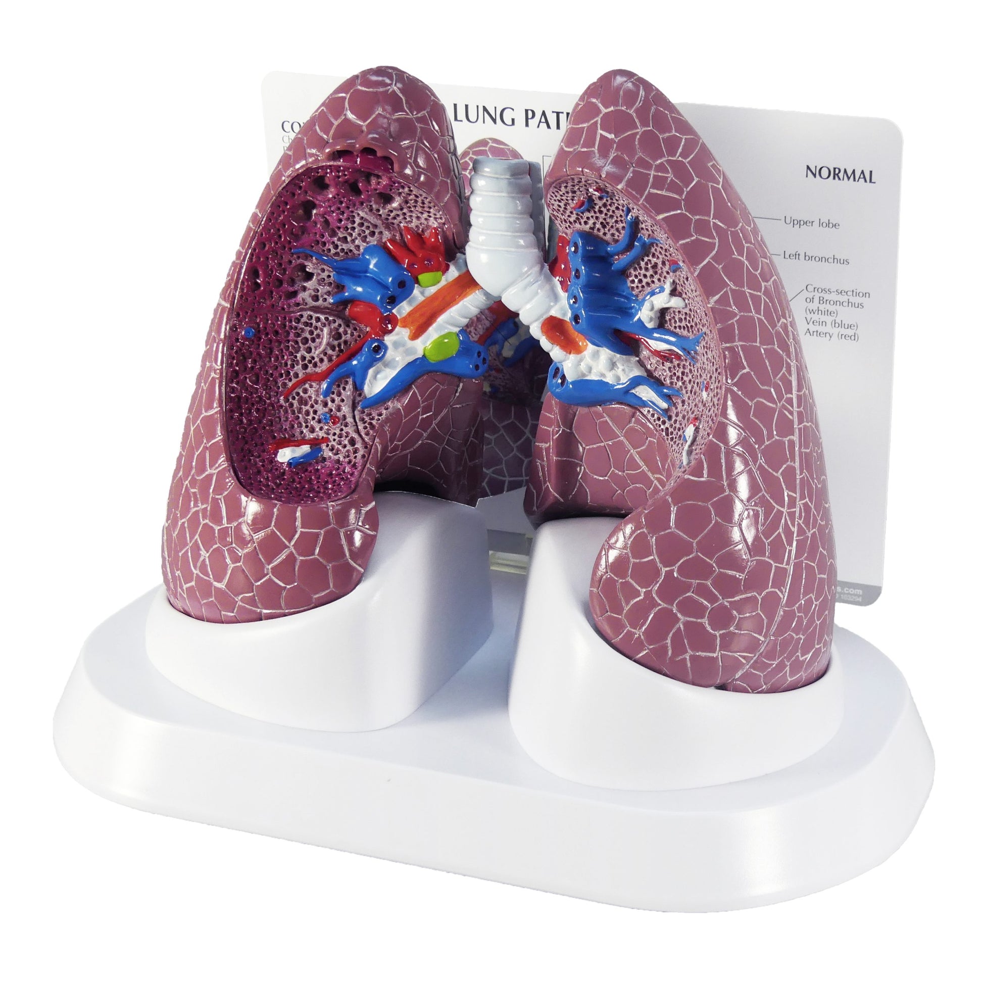 Diseased Lung Model (COPD, Cancer, Asthma)