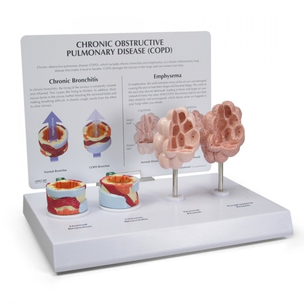 Chronic Obstructive Pulmonary Disease Model and Chart