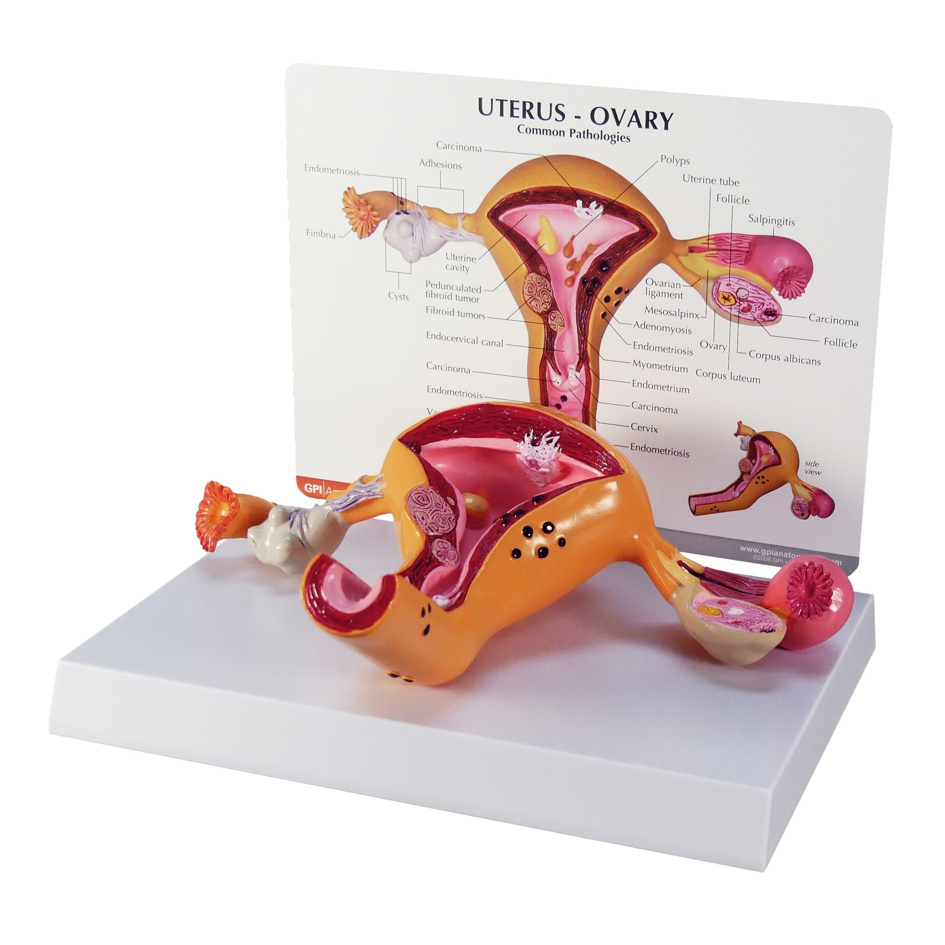 Diseased Uterus and Ovaries Model