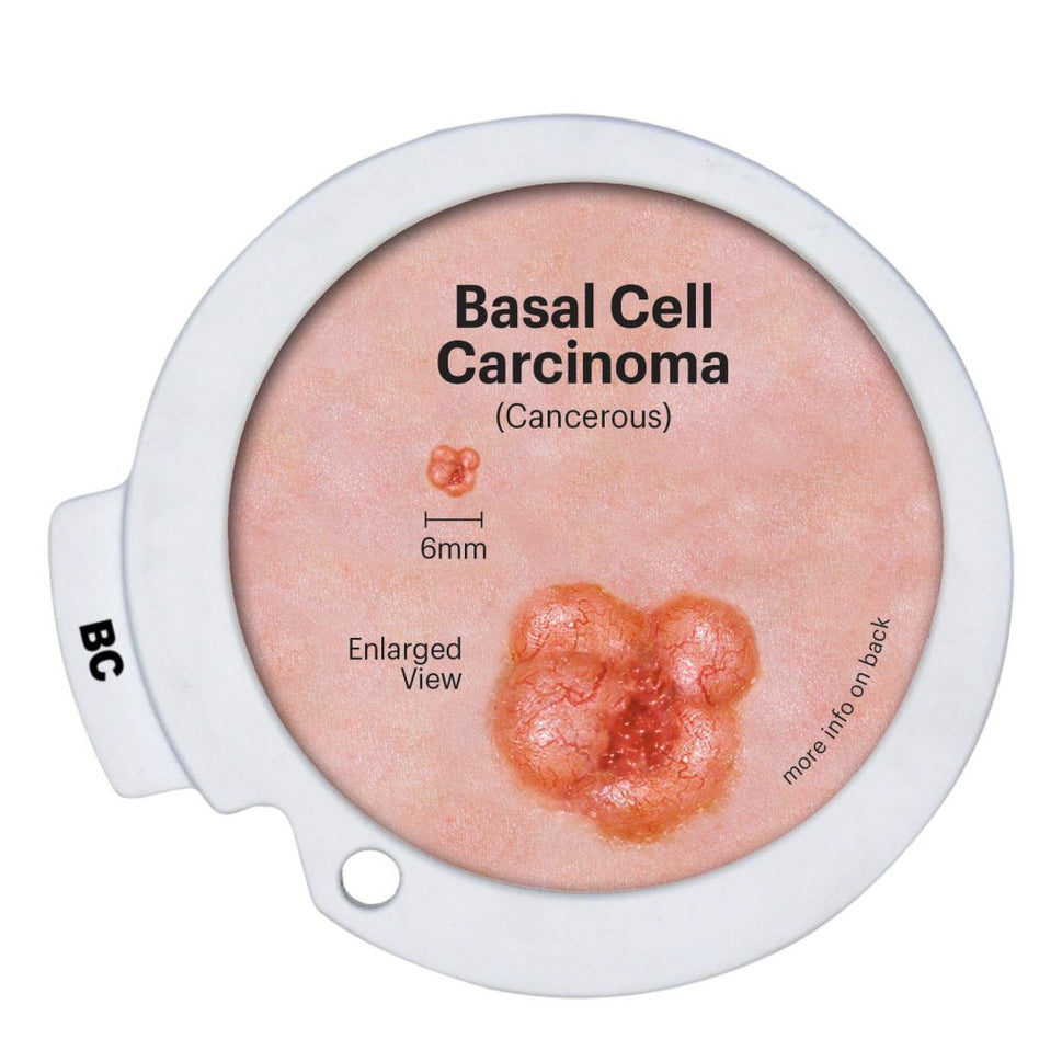 Precancerous and Cancerous Skin Lesions Disk Set