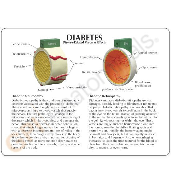 Diabetes Model (4 piece)