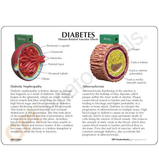 Diabetes Model (4 piece)