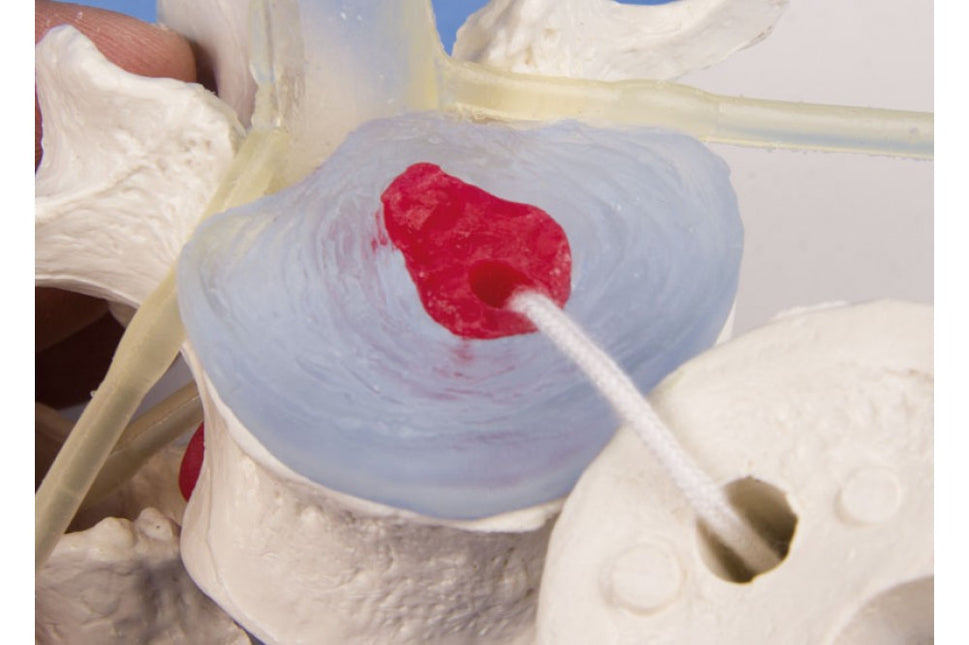 Lumbar Vertebrae Model with Prolapsed Disc