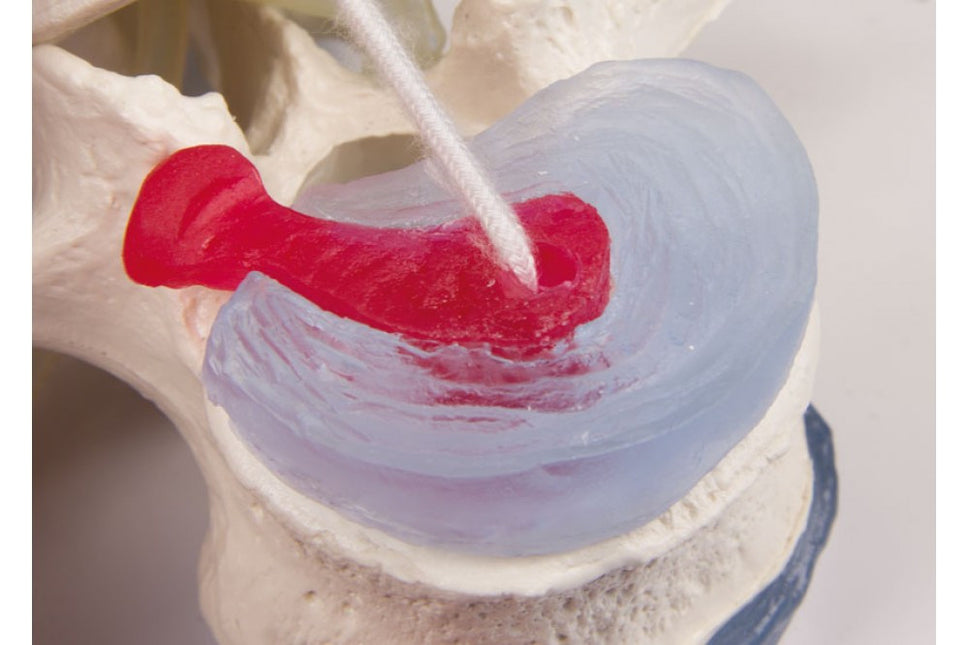 Lumbar Vertebrae Model with Prolapsed Disc