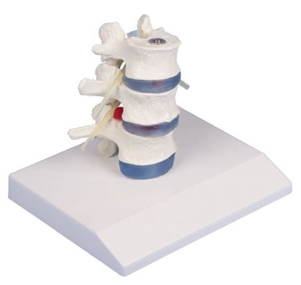 Lumbar Vertebrae Model with Prolapsed Disc