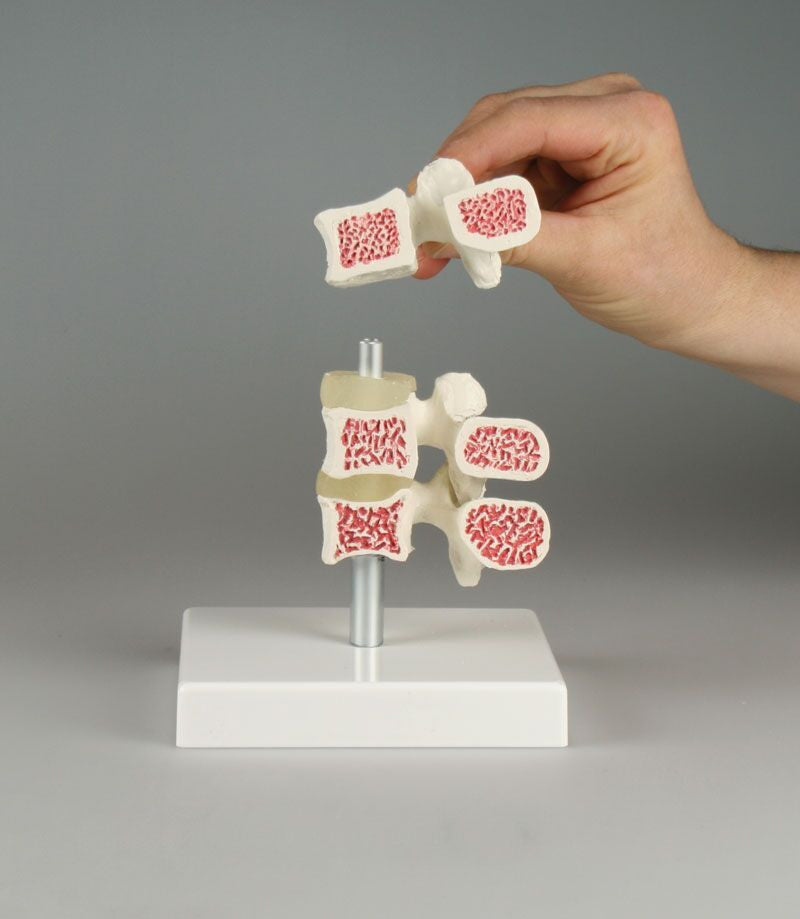 Osteoporosis Vertebrae Model