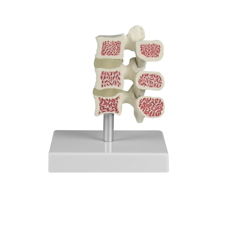 Osteoporosis Vertebrae Model