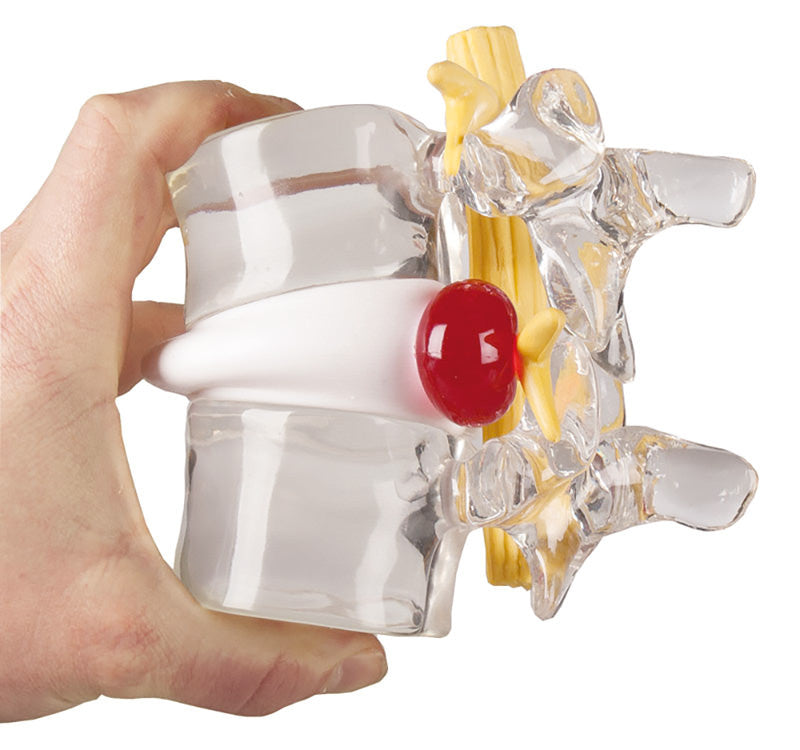 Herniated Disc Simulator