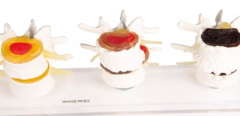 Stages of Disc Degeneration Model