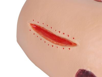 Deep tissue injury example on the "Decubitus Dan" Care and Dressing Simulator