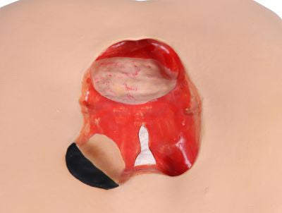 Pressure ulcer example on the "Decubitus Dan" Care and Dressing Simulator