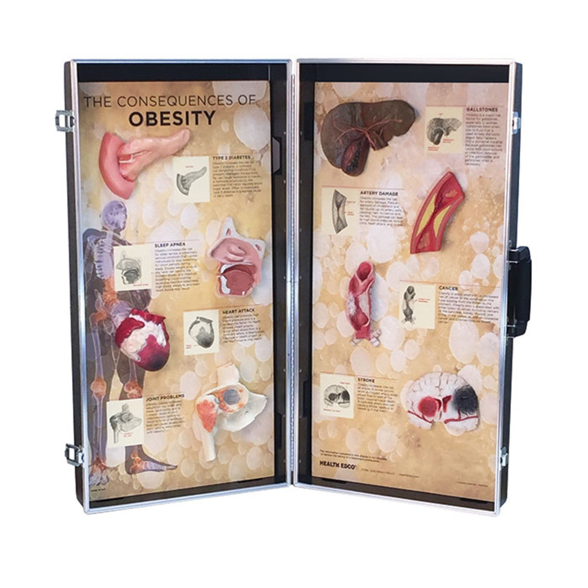 The Consequences of Obesity 3D Display